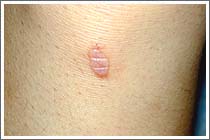 口腔扁平苔癬歯科口腔外科症例解説東京銀座シンタニ歯科口腔外科クリニック