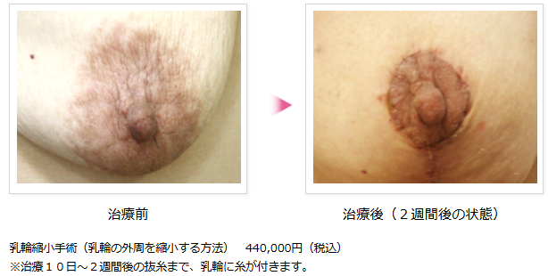 男性が許せない女性のムダ毛 口コミ・評判新宿美容外科クリニック 公式