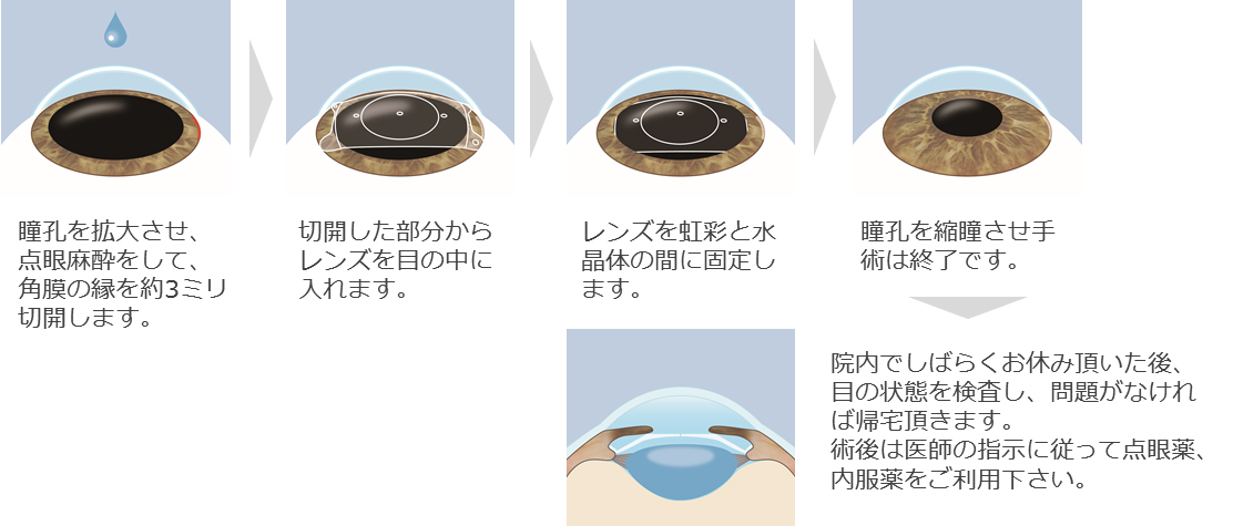 グッドバイ！めがね・コンタクト―１５分のＲＫ手術で近視・乱視が治る オルソケラトロジー