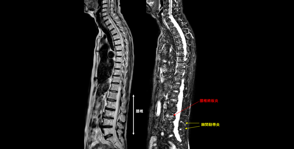棘上靭帯に起こる病気は？棘上靭帯炎の検査方法・リハビリを解説！HALII TOKYO