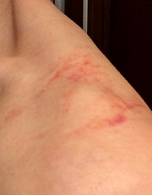 2025年版 内出血と皮下出血の原因から治癒過程まで徹底解説！血液データ・脳卒中後の薬剤との関連性と観察ポイントも詳述 – STROKE LAB東京 大阪 自費リハビリ脳卒中 神経系