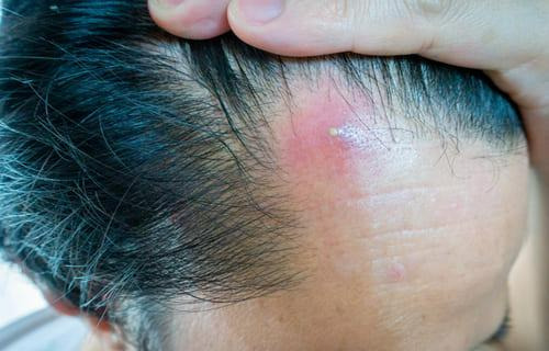 医師監修 繰り返すうなじニキビの徹底治療！原因から予防方法まで詳しく解説ハダメディア by BIHADADO.TOKYO