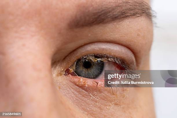 ものもらい 麦粒腫 霰粒腫 の原因と治療について西川口の森田眼科