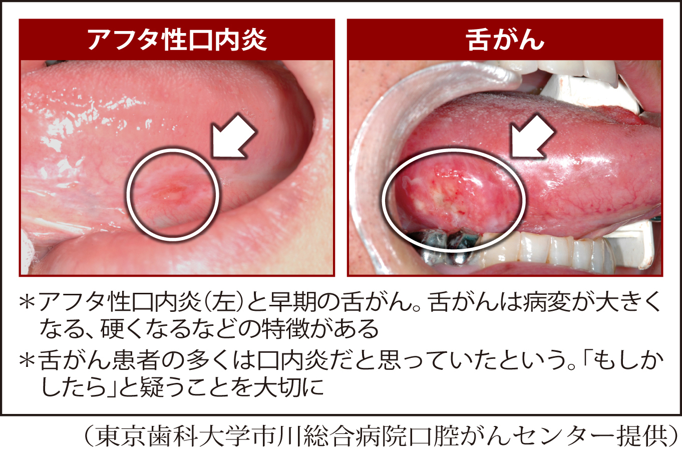 口内炎原因・症状・対策・予防法大正健康ナビ大正製薬