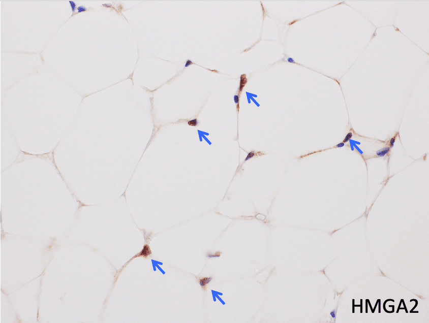 脂肪腫 lipoma のCT、MRI画像所見のポイント