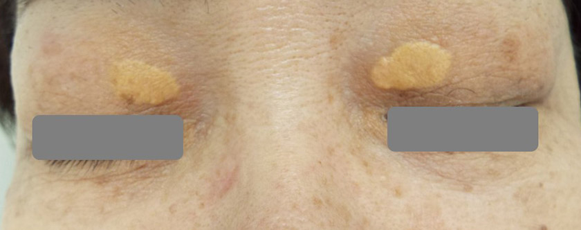 目頭切開 その後 、黒子 ホクロ 、黄色腫横浜市鶴見の形成・美容外科 エムズクリニック