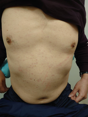 急増する梅毒一般社団法人安佐医師会 可部夜間急病センタ