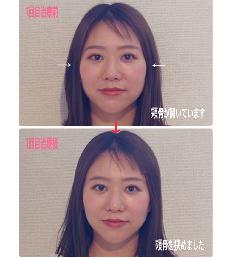 何センチなら小顔なの？あなたの顔の大きさは〇〇で決まる！おすすめの小顔整形も紹介アールビューティークリニック銀座・名古屋・大阪美容整形・美容外科・美容皮膚科