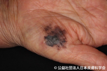 時々、手相が診断の役に立つことがあります。粉瘤・ほくろ除去で皮膚科をお探しなら はなふさ皮膚科へ