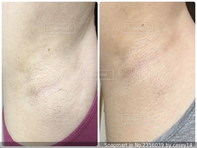 秋田ワキ脱毛 ※20代女性 ※毛が伸びるのが遅くなった秋田女子の脇毛いらねぐね？プロジェクト女子は損な事に脇毛を生やしておくことができません。剃るなら脱毛行ってみよー！秋田脱毛サロン秋田個人脱毛サロン秋田アフターメンテナンス脱毛個人脱毛サロン