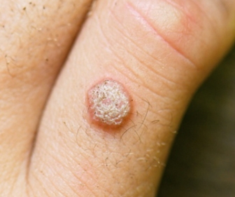 指にイボが出来て数も増えて肥大してます。早く除去したいです。ほくろ除去・あざ治療・イボ治療の治療方法・適応