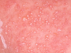 皮膚カンジダ症の写真 - 医療のイラスト・写真・動画、素材販売サイトのメディック medick