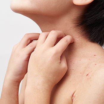 背中野田市 小児科 千葉県 こどもの花粉症 こどもの漢方 喘息 アトピー性皮膚炎 アレルギー 結節性痒疹 たんぽぽこどもクリニック