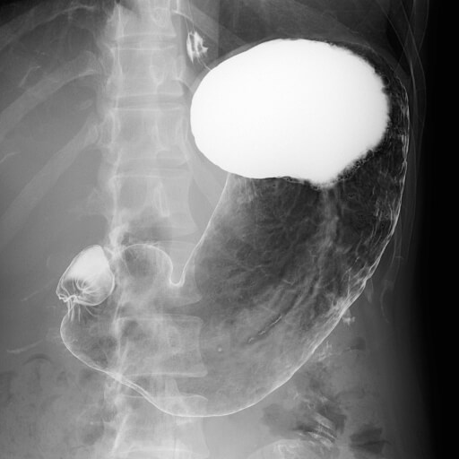 バリウム 胃部X線 検査って？~Fin~世代-SeDaI