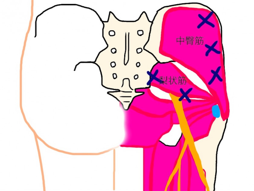 片方のおしりが痛くなる原因5つを紹介！何科を受診したら良い？ - 中村AJペインクリニック