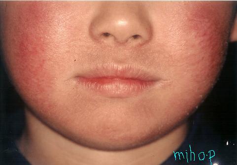 皮膚病。皮膚感染症、湿疹、乾癬。皮膚科のベクターイラスト。皮膚炎感染症」のベクター画像素材 ロイヤリティフリー1154905705Shutterstock