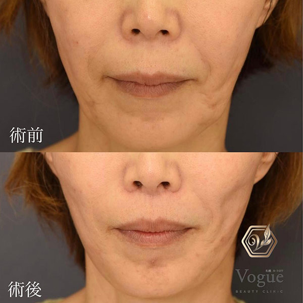 人中が長い・中顔面が間延びして見える原因は？“中顔面短縮”で整える顔バランス整形術MAe Clinic マエクリ