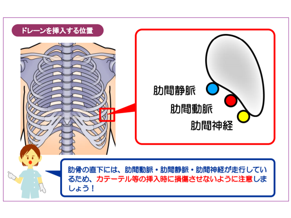 胸腔ドレーン挿入時に臓器・血管を傷つける事故が散発、挿入時の留意はもちろん、挿入後の確認・モニタリング徹底を―PMDAGemMedデータが拓く新時代医療