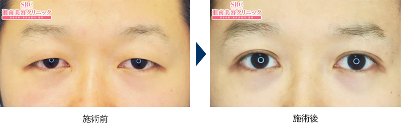 ひとえまぶたの不都合な真実 〜ふたえまぶたの人にはわからない！？〜社会医療法人蘇西厚生会 松波総合病院