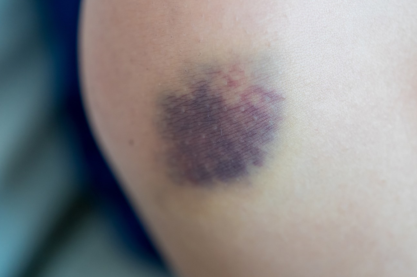 身に覚えのないあざの原因は？女性や高齢者に多い皮膚病を解説- ヨクミテ医師監修の医療メディア