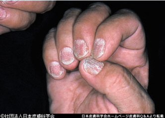 乾癬 かんせん- つくば・土浦鶴町皮膚科クリニック