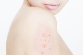 とびひ 伝染性膿痂疹とびひ でんせんせいのうかしん家庭の医学時事メディカル時事通信の医療ニュースサイト