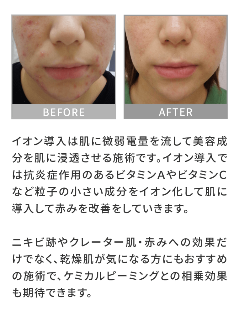 首ニキビ 首にニキビができる原因と改善方法大阪堺市 ニキビケア肌育エステサロン シエスタ