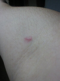 点滴終了。腕が針の跡だらけ- Photozou