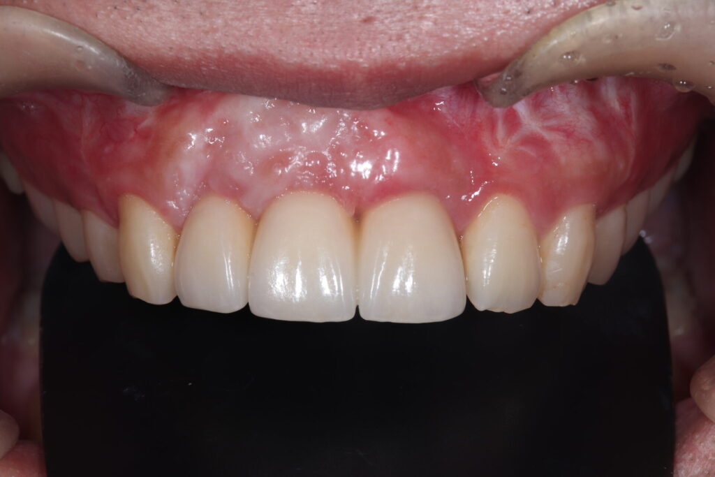 歯 複数 右のイラスト素材53647153- PIXTA