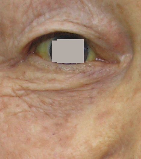 新生児黄疸 おうだん とは？ 原因や症状、いつまで続くかを詳しく解説ママパーク