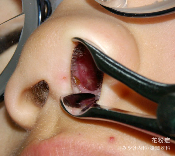 急な片方の鼻づまりは注意~鼻内の腫瘍 - 熊本 くまモンファン 耳鼻咽喉科医の みみ・はな・のど あれこれ