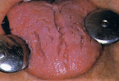 地図状舌口腔外科症例解説東京銀座シンタニ歯科口腔外科クリニック