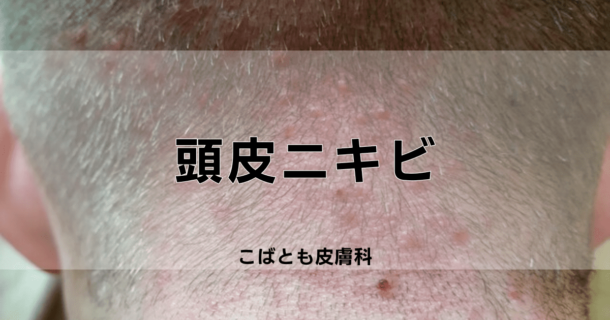 首すじの吹き出物を解決したい～後編茨城県北茨城市の男性専門マンツーマンヘアサロン