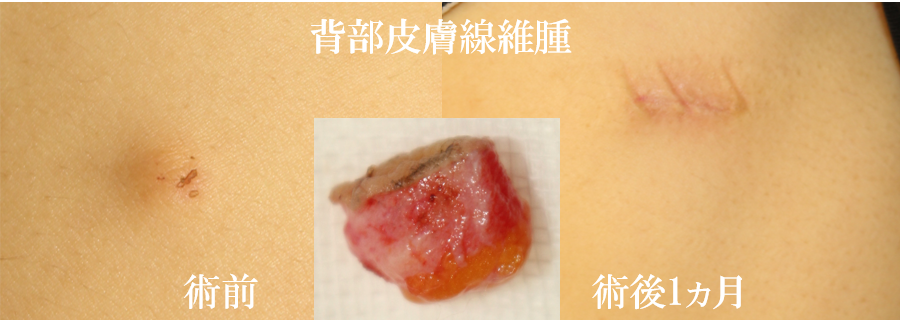 軟線維腫豊洲佐藤クリニック