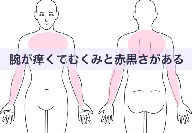首に帯状疱疹が現れたら？早めの治療を考えよう！ - 中村AJペインクリニック