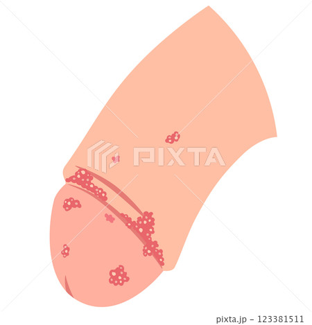 尖圭コンジローマ について原因・症状・治療など 吉祥寺まいにちクリニック 内科・皮膚科・泌尿器科