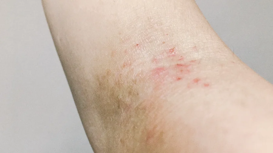 あせも 汗疹 治し方・原因・症状・対処法・予防法大正健康ナビ大正製薬