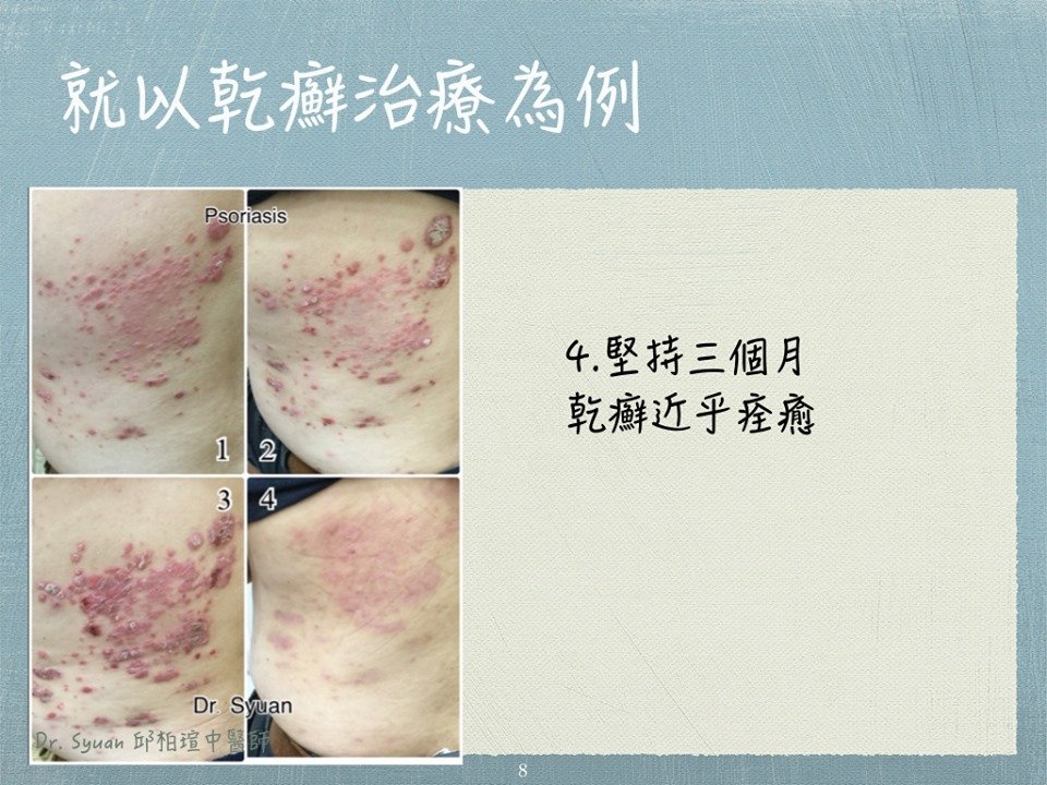 EP144. 跨界 到底是頭皮屑還是乾癬？！快看看自己有沒有這些症狀！ FT.長庚醫院蔡昀臻醫師- 引人入腎-醫學白話文衛教知識平台，讓腎友輕鬆理解健康知識