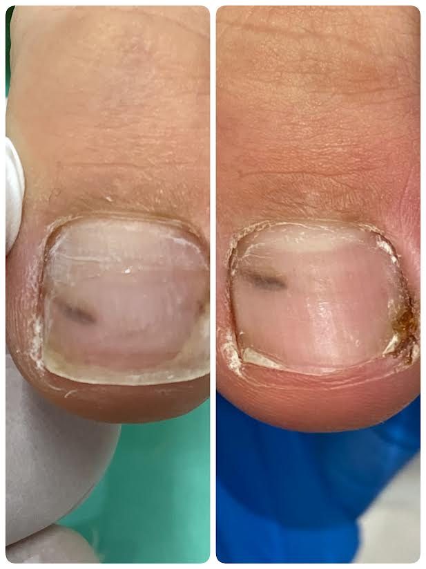 お爪の内出血Foot Care Salon Runka