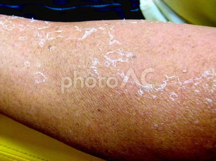 うっかり日焼け、正しい対処法👨🏻‍⚕️日差しが強い日が続いていますね😥☀️ 外や水場に長時間いる場合は、やけどをしたような日焼けをしてしまう方も💦 そこで今回は日焼けしてしまった時の対処法を段階別に解説✍️ ホームケアとクリニックの治療も、まとめている