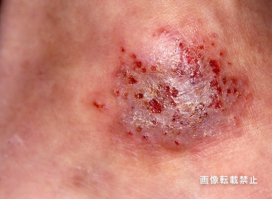 皮膚炎の種類まとめ 原因・症状・湿疹との違いをわかりやすく解説 大峰堂の漢方Store