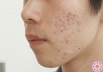 頭皮ニキビはなぜできるの？皮膚科の先生に聞いた頭皮ニキビの原因と対策を紹介 - OZmall