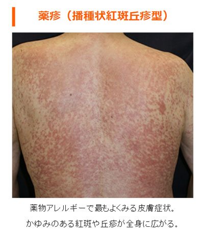 クミタス 読み物 イチョウ種子・葉による皮膚症状、ぎんなんによる中毒について