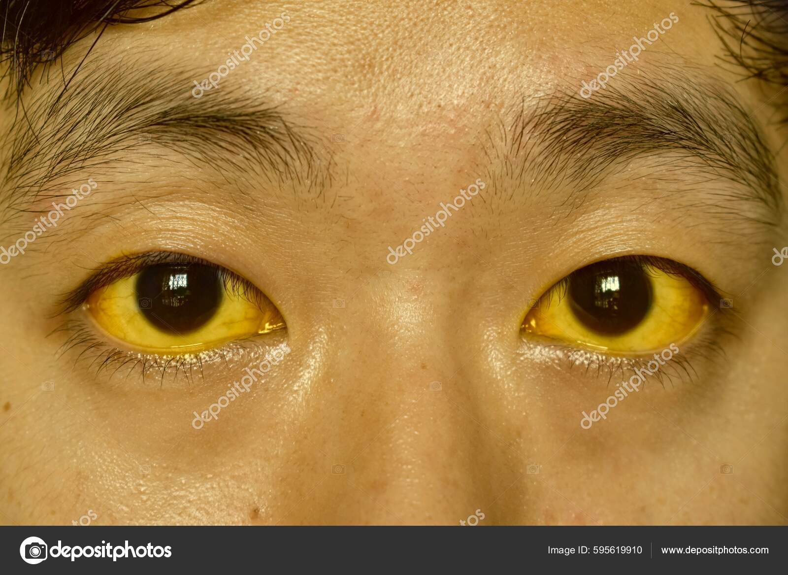 目の黄ばみ：原因と対応