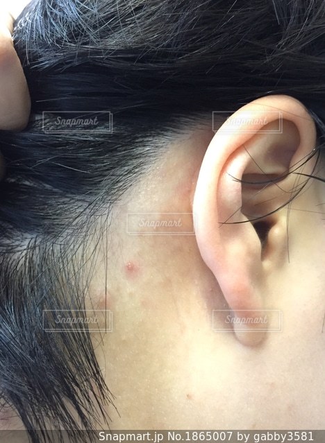 なぜ？耳の後ろの腫れを触ると痛い。大丈夫？病院は何科？ 医師監修Medicalook メディカルック