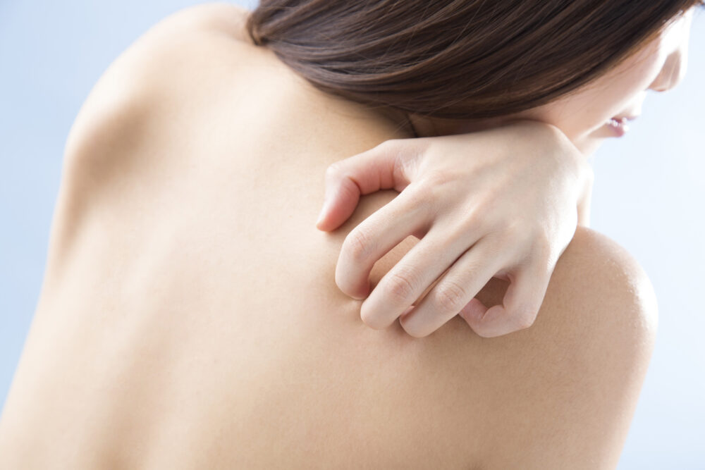 大人あせもの写真・画像素材-Snapmart スナップマート