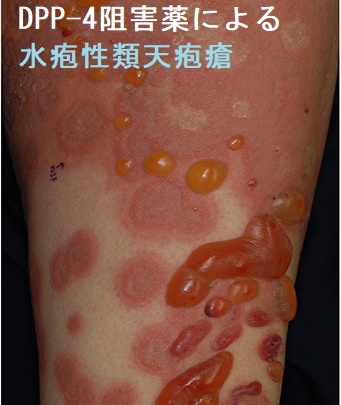 糖尿病による皮膚トラブルを回避するためのフットケアとは？やり方を紹介