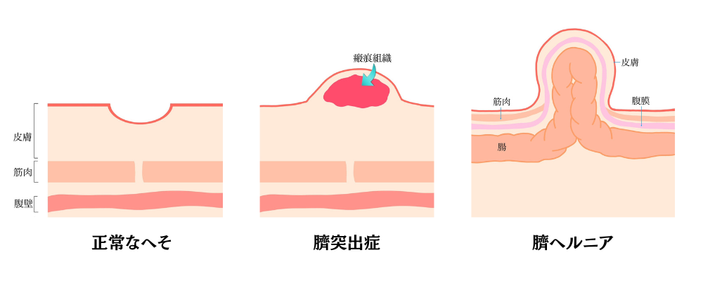 臍ヘルニアの治療は大阪日帰り外科そけいヘルニアクリニック