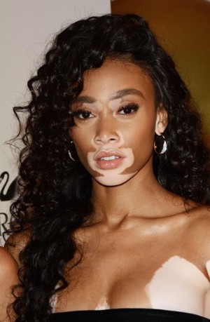 やっと見つけた🌟🌟🌟 以前からお伝えしている長女の尋常性白斑5歳で発症し、治療や薬はしてるけど、日々広がっていった額と頭皮の皮膚の白さと白髪。 ⁡ ⁡ 髪型は伸ばしてたので、ゴムでよく結んでたけど、夏場は太陽光にあたり過ぎると皮膚がそこだけ真っ赤になり