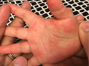 薬疹、多形紅斑皮膚科広島市立北部医療センター安佐市民病院